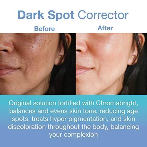 Dark Spot Remover Skin Care Treatment U286575